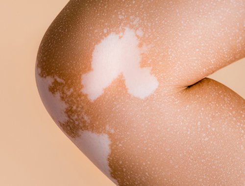 IGF/Insulin Signaling and Glucose Metabolism as Therapeutic Targets in Vitiligo